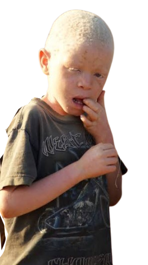 albinos